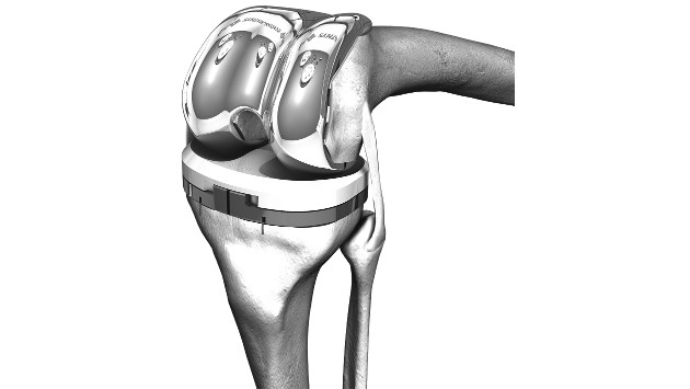 Eine grafische Darstellung künstlicher Kniegelenkteile